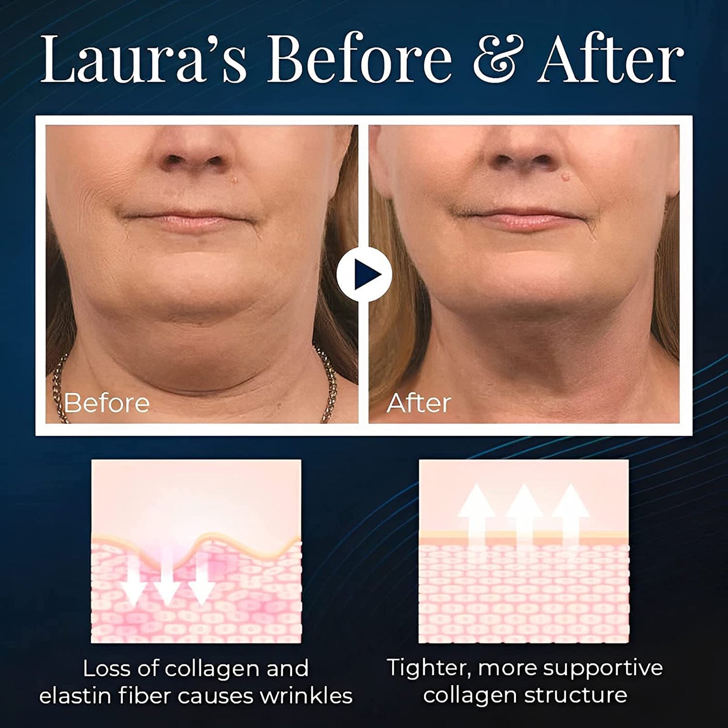 Phonery V-Perfect ® V Face Shaper-Getphonery
